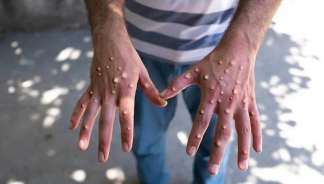 Monkeypox: Kazakh Health Ministry tightens border and airport controls