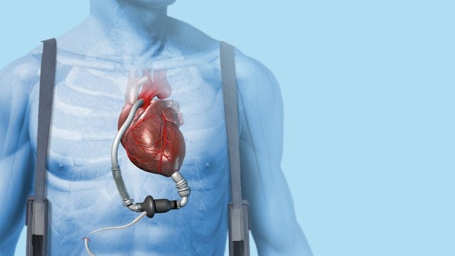 Artificial heart implantation performed in Shymkent